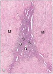 <strong>A 46 year old mother of three saw her GP who noticed a symmetrically enlarged uterus with no masses.A pregnancy test was negative.Since she already had three children,the woman elected to have a vaginal hysterectomy.A histological section from the myometrium is shown in the accompanying photomicrograph.Which one of the following is the best diagnosis? </strong> A)Adenomyosis B)Endometriosis C)Endometrial polyp D)Endometrioid carcinoma E)Leiomyoma
