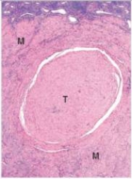 <strong>A 38 year old woman is seen by her GP for increasing pelvic pain and abnormal uterine bleeding.The GP palpates several firm masses in the uterus.The patient is referred to a gynaecologist who recommends and eventually performs a vaginal hysterectomy.A representative section of the uterus is shown in the accompanying photomicrograph.Which one of the following is the best diagnosis? </strong> A)Adenomyosis B)Endometriosis C)Leiomyoma D)Leiomyosarcoma E)Thrombus