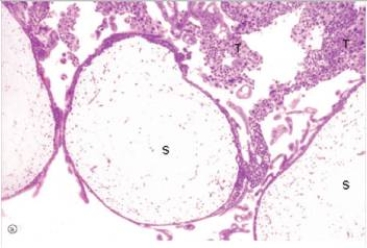 <strong>A 27 year old woman suspected she was pregnant,and performed a home pregnancy test,which was positive.However,a few weeks later,when she had her first ultrasound,no foetus was detected.Instead,the uterus was filled with round,grape-like masses.A dilation and curettage (D&C)was then performed.Tissue from the procedure was sent to surgical pathology,and a representative section from this material is shown in the accompanying photomicrograph.Which one of the following is the best diagnosis? </strong> A)Endometrial carcinoma B)Endocervical polyp C)Endometrial polyp D)Hydatidiform mole E)Infection with hydatid tapeworm