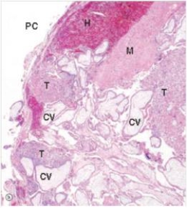 <strong>A 24 year old woman came to the emergency department with severe abdominal pain and vaginal bleeding.A physician palpated a mass in the right fallopian tube.A pregnancy test was positive.She was taken to the OR for emergency laparotomy (exploration of the abdomen)and the right fallopian tube and mass were removed.A representative section is shown in the accompanying photomicrograph.Which one of the following is the best diagnosis? </strong> A)Acute salpingitis B)Choriocarcinoma C)Ectopic pregnancy D)Endometrial carcinoma E)Endometriosis F)Tubo-ovarian abscess