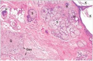 <strong>A 20 year old woman consulted the Students' Health Service GP at her university because of an enlarging abdomen and abdominal fullness.Friends had been asking her if she was pregnant,but she was not sexually active.The physician palpated a large mass in the right ovary.She underwent an exploratory laparotomy (abdominal exploration),and an 8 cm tumour was removed,along with the right ovary.When sectioned,the tumour containing a mass of oily hair.A representative section is shown in the accompanying photomicrograph.Which one of the following is the best diagnosis? </strong> A)Brenner tumour B)Cystic teratoma C)Mucinous cystadenoma D)Mucinous cystadenocarcinoma E)Serous cystadenoma F)Serous cystadenocarcinoma