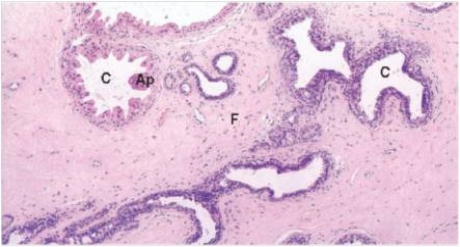<strong>A 40 year old woman consulted her GP because she felt a lump in her breast.The GP found the lump and felt that,since the mass seemed to change in size with her menstrual periods,it was likely a benign process.Because she had a sister with breast cancer,and to avoid excessive worry on the part of the patient,a biopsy was performed.A representative section is shown in the accompanying photomicrograph.Which one of the following is the best diagnosis?  </strong> A)Ductal carcinoma in situ B)Fibroadenoma C)Fibrocystic change D)Gynaecomastia E)Infiltrating ductal carcinoma F)Infiltrating lobular carcinoma G)Lobular carcinoma in situ <div style=padding-top: 35px> 