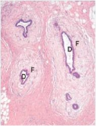 <strong>A 55 year old man was undergoing oestrogen treatment for his prostatic adenocarcinoma.He noticed bilateral swelling in his breasts.Because of the cosmetic nature of the disorder,the bilateral breast tissue was removed,and a representative section is shown in the accompanying photomicrograph.Which one of the following is the best diagnosis?  </strong> A)Ductal carcinoma in situ B)Fibroadenoma C)Fibrocystic change D)Gynaecomastia E)Infiltrating ductal carcinoma F)Infiltrating lobular carcinoma G)Lobular carcinoma in situ <div style=padding-top: 35px> 