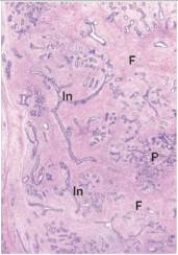 <strong>A 23 year old woman noted a firm,mobile,2 cm mass in her right breast.Alarmed,she consulted her GP,and it was removed.A representative section of the mass is shown in the accompanying photomicrograph.Which one of the following is the best diagnosis?  </strong> A)Ductal carcinoma in situ B)Fibroadenoma C)Fibrocystic change D)Gynaecomastia E)Infiltrating ductal carcinoma F)Infiltrating lobular carcinoma G)Intraductal papilloma H)Lobular carcinoma in situ <div style=padding-top: 35px> 
