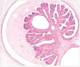 <strong>A 28 year old woman consulted her GP because she felt a mass in her breast,just below the nipple.She had also noted a bloody discharge from the same nipple,and was quite concerned.The GP told her it was likely benign,and the mass was later removed surgically.A representative section is shown in the accompanying photomicrograph.Which one of the following is the best diagnosis?  </strong> A)Ductal carcinoma in situ B)Fibroadenoma C)Fibrocystic change D)Gynaecomastia E)Infiltrating ductal carcinoma E.Infiltrating ductal carcinoma F)Infiltrating lobular carcinoma G)Intraductal papilloma H)Lobular carcinoma in situ <div style=padding-top: 35px> 