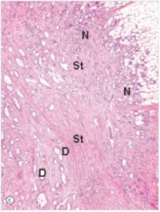 <strong>A 58 year old woman noted a mass in her breast,for which she sought advice from her GP.The physician felt the mass,but also noticed skin retraction over the lesion.A biopsy was done,revealing the histological appearance shown in the accompanying low power photomicrograph.Which one of the following is the best diagnosis?  </strong> A)Ductal carcinoma in situ B)Fibroadenoma C)Fibrocystic change D)Gynaecomastia E)Infiltrating ductal carcinoma F)Infiltrating lobular carcinoma G)Intraductal papilloma H)Lobular carcinoma in situ <div style=padding-top: 35px> 