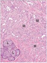<strong>A 49 year old woman found a mass in each of her breasts.After consultation with a surgeon,bilateral biopsies were done,revealing the histology seen in the accompanying photomicrograph.How would you classify the malignant cells (M)seen?  </strong> A)Ductal carcinoma in situ B)Fibroadenoma C)Fibrocystic change D)Gynaecomastia E)Infiltrating ductal carcinoma F)Infiltrating lobular carcinoma G)Intraductal papilloma H)Lobular carcinoma in situ <div style=padding-top: 35px> 
