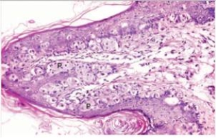 <strong>A 63 year old woman consulted her GP because of a rash on her left nipple.It had been weeping clear fluid for some weeks,and was reddened.A biopsy was done,and a representative section is shown in the accompanying photomicrograph.Which one of the following conclusions is warranted?  </strong> A)Application of a hydrocortisone cream is indicated B)She has an underlying breast carcinoma C)She needs to apply sunscreen while sunbathing to avoid such basal cell carcinomas D)The lesion should heal on its own E)The patient is pregnant <div style=padding-top: 35px> 