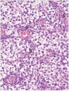 <strong>A 28 year old man sees his GP about a 2 cm firm mass in his right testis.The GP examines it and recommends immediate removal of the tumour.The testis and spermatic cord are surgically removed shortly thereafter,and a representative section of the tumour is shown in the accompanying photomicrograph.Which one of the following is the best diagnosis? </strong> A)Embryonal carcinoma B)Immature teratoma C)Seminoma D)Torsion of the testis E)Yolk sac tumour