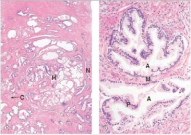 <strong>A 55 year old man consults his GP for trouble with urination.He has difficulty both starting and stopping his stream.He often has to get up 2-3 times per night to urinate.The physician palpates a nodular prostate,and a needle biopsy is performed,to rule out carcinoma.A representative section is shown in the accompanying photomicrograph.Which one of the following is the best diagnosis? </strong> A)Acute prostatitis B)Chronic prostatitis C)Benign prostatic hyperplasia (BPH) D)Prostatic adenocarcinoma E)Prostatic intraepithelial neoplasia