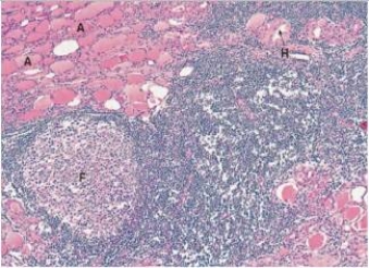 <strong>A 36 year old woman noticed a lump in her neck.When seen by her GP,she also noted that she had been fatigued lately.He palpated a nodular thyroid that was somewhat tender.Because of the cosmetic defect that the patient felt,the thyroid was removed.A representative section is shown in the accompanying photomicrograph.Which one of the following is the best diagnosis? </strong> A)Follicular carcinoma B)Graves' disease C)Hashimoto's thyroiditis D)Multinodular goitre E)Papillary carcinoma F)Thyroid adenoma