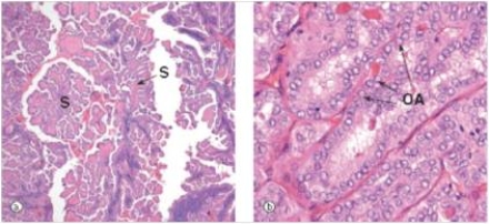 <strong>A 24 year old woman noted a swelling in her neck.She sought advice from her GP who also noticed some enlarged cervical lymph nodes.The GP recommended she have her thyroid gland surgically removed,which was accomplished within the week.A representative section of the gland is shown in the accompanying photomicrograph.Which one of the following is the best diagnosis? </strong> A)Follicular carcinoma B)Graves' disease C)Hashimoto's thyroiditis D)Multinodular goitre E)Papillary carcinoma F)Thyroid adenoma