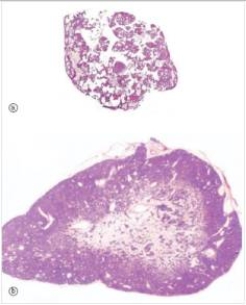 <strong>A 57 year old woman with diabetes and chronic renal failure was experiencing several bouts with kidney stones.These were proven to be derived from calcium,and her serum calcium level was found to be high normal.Her parathyroid glands were all removed,and a representative gland is shown in the bottom photomicrograph,compared to a normal parathyroid (from another patient)in photo (a).Which one of the following is the best diagnosis? </strong> A)Metastatic adenocarcinoma B)Parathyroid adenoma C)Parathyroid carcinoma D)Parathyroid hyperplasia E)Pituitary adenoma