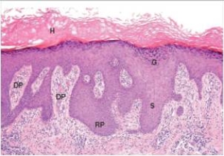 <strong>The thickening of the epidermis in this photomicrograph is due primarily to enlargement of which one of the following epidermal layers?  </strong> A)Dermis B)Dermal papillae C)Keratin layer (hyperkeratosis) D)Rete ridges (acanthosis) <div style=padding-top: 35px> 