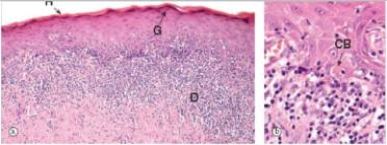 <strong>A 45 year old woman noticed a whitish patch on the skin of her forearm.Her GP biopsied the lesion,which a pathologist eventually diagnosed as lichen planus.A representative section is shown in the accompanying photomicrograph.How would you characterise the structure marked CB in the high power photo on the right?  </strong> A)Apoptotic body B)Artifact C)Fungus D)Mite E)Inflammatory cell <div style=padding-top: 35px> 