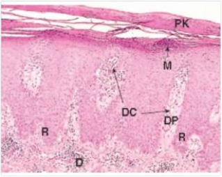 <strong>A 35 year old woman had silver patches surrounded by erythema (redness)on her elbows and knees.A biopsy was done,and a representative section is shown in the accompanying photomicrograph.Which one of the following is the best diagnosis?  </strong> A)Basal cell carcinoma B)Lichen planus C)Molluscum contagiousum D)Psoriasis E)Squamous cell carcinoma F)Viral warts <div style=padding-top: 35px> 