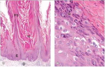 <strong>A 4 year old boy developed raised bumps on his fingers.His friends at his pre-school had similar lesions.A biopsy of one of the lesions is shown in the accompanying photomicrograph.Which one of the following is the best diagnosis?  </strong> A)Basal cell carcinoma B)Lichen planus C)Molluscum contagiousum D)Psoriasis E)Squamous cell carcinoma F)Viral warts <div style=padding-top: 35px> 