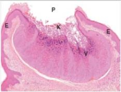 <strong>A 4 year old boy developed raised bumps on his fingers.His friends at his pre-school had similar lesions.A biopsy of one of the lesions is shown in the accompanying photomicrograph.Which one of the following is the best diagnosis?  </strong> A)Basal cell carcinoma B)Lichen planus C)Molluscum contagiousum D)Psoriasis E)Squamous cell carcinoma F)Viral warts <div style=padding-top: 35px> 