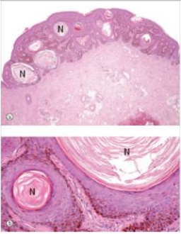 <strong>A 75 year old man had several brown,raised lesions on his arms.One of them began to bleed,after he snagged it while putting on his shirt.Fearing melanoma,he consulted his GP,who removed it.A representative section is shown in the accompanying photomicrograph.Which one of the following is the best diagnosis?  </strong> A)Actinic keratosis B)Basal cell carcinoma C)Compound naevus D)Malignant melanoma E)Seborrhoeic keratosis F)Superficial spreading malignant melanoma G)Squamous cell carcinoma <div style=padding-top: 35px> 