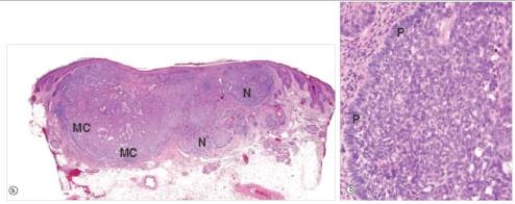 <strong>A 39 year old female consulted her GP because of a small,non-healing ulcer that appeared on her nose.Upon examination,she was overly tanned,and had a 0.8 cm diameter lesion with pearly white raised edges on the right side of her nose.The lesion was completely excised.A representative section is shown in the accompanying photomicrograph.Which one of the following is the best diagnosis?  </strong> A)Actinic keratosis B)Basal cell carcinoma C)Compound naevus D)Malignant melanoma E)Seborrheic keratosis F)Superficial spreading malignant melanoma G)Squamous cell carcinoma <div style=padding-top: 35px> 