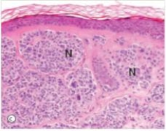 <strong>How would you classify the pigmented lesion shown in the accompanying photomicrograph?  </strong> A)Intradermal naevus B)Junctional naevus C)Malignant melanoma D)Seborrheic keratosis E)Superficial spreading melanoma <div style=padding-top: 35px> 