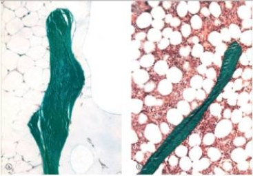 <strong>A 55 year old woman fell while touring London.She sustained a fracture of her humerus,just below the head of the humerus.The fracture was surgically repaired and sample of bone tissue was taken and sent to pathology.The sample is shown in the accompanying image with normal bone on the left for comparison.Both sections are undecalcified,and are stained with Goldner's trichrome,which stains uncalcified osteoid pink,and calcified matrix green.Which one of the following diagnoses is most likely correct?  </strong> A)Osteogenic sarcoma B)Osteoporosis C)Osteomalacia D)Osteomyelitis E)Paget's disease of bone <div style=padding-top: 35px> 