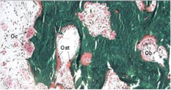 <strong>A 70 year old man complained of headache to his GP.He thought something was seriously wrong,because he had noticed his hat size was also increasing,and he feared underlying bone cancer.A biopsy of his skull was performed,and is compared with normal bone on the left.Both sections are undecalcified,and are stained with Goldner's trichrome,which stains uncalcified osteoid (Ost)pink,and calcified matrix green.Which one of the following diagnoses is most likely correct?    </strong> A)Osteogenic sarcoma B)Osteoporosis C)Osteomalacia D)Osteomyelitis E)Paget's disease of bone <div style=padding-top: 35px> 