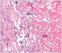 <strong>A 15 year old boy was kicked in the leg during a football game.The coach put ice on it,and he seemed ok,but three weeks later,he still had pain above his knee that kept him awake at night.An x-ray revealed a large mass in the femur.A biopsy was performed,a representative section of which is shown in the accompanying photomicrograph.Which one of the following is the best diagnosis?  </strong> A)Chondrosarcoma B)Fracture,with non-union C)Osteogenic sarcoma D)Osteoid osteoma E)Paget's disease of bone <div style=padding-top: 35px> 