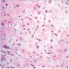 <strong>A 69 year old man was seen by his GP for pain in the right hip.An x-ray revealed a large mass involving the pelvis that was pressing on the joint.A biopsy was performed,and a representative section is shown in the accompanying photomicrograph.Which one of the following is the best diagnosis?  </strong> A)Chondrosarcoma B)Fracture,with non-union C)Osteogenic sarcoma D)Osteoid osteoma E)Paget's disease of bone <div style=padding-top: 35px> 