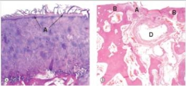 <strong>A 55 year old former long-distance runner consulted his GP because of pain in his knee.The joint space was severely narrowed,and the pain was intolerable.Knee replacement was done.A sample of the tissue removed is shown in the accompanying photomicrograph.Which one of the following is the best diagnosis?  </strong> A)Gout B)Osteomalacia C)Osteoporosis D)Osteoarthritis E)Rheumatoid arthritis <div style=padding-top: 35px> 