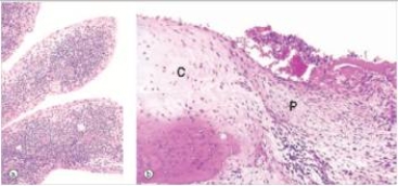 <strong>A 39 year old woman consulted her GP because of bilateral pain in her knees.The knees appeared swollen.The joint space was markedly decreased.Knee replacement was done,and representative tissue removed during replacement surgery is shown in the accompanying photomicrograph.  </strong> A)Gout B)Osteomalacia C)Osteoporosis D)Osteoarthritis E)Rheumatoid arthritis <div style=padding-top: 35px> 