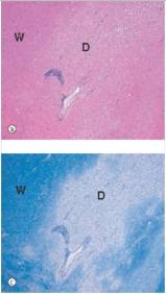 <strong>A 32 year old woman suddenly developed paraplegia in her right leg.This caused her to crash her car.A coroner's autopsy was ordered.A representative section from the area of the internal capsule in the brain disclosed the findings seen in the accompanying photomicrographs,with H&E in the upper photo (a)and a Luxol fast blue myelin stain in the lower photo (c).Which one of the following is the best diagnosis? </strong> A)Glioblastoma B)Herpes simplex virus encephalitis C)Infarction D)Meningioma E)Multiple sclerosis