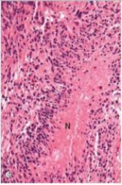 <strong>A 45-year-old woman woke up in the morning with a severe headache.She did not recognize her husband of 20 years.She then experienced a grand mal seizure.Her husband called an ambulance,and she was taken to the hospital.A CT scan disclosed a large tumour,deep in the cerebrum,that crossed the midline near the corpus callosum.Necrosis was evident throughout the tumour.A brain biopsy of a portion of the tumour was done and a representative section is shown in the accompanying photomicrograph.Which one of the following is the best diagnosis? </strong> A)Ependymoma B)Glioblastoma C)Meningioma D)Medulloblastoma E)Oligodendroglioma