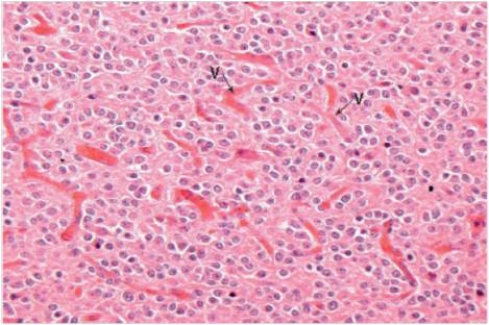 <strong>A 44 year old man began exhibiting bizarre personality changes,noted first by his wife.She brought him to the local Emergency Department,where a neuropsychiatrist ordered a CT scan.The scan revealed a 3 cm,well-demarcated tumour in the frontal lobes.Calcification was evident within the tumour.A neurosurgeon was consulted,and the tumour was later removed without incident.The patient returned to his normal state.A representative section of the tumour is shown in the accompanying photomicrograph.Which one of the following is the best diagnosis? </strong> A)Ependymoma B)Glioblastoma C)Meningioma D)Multiple sclerosis E)Oligodendroglioma