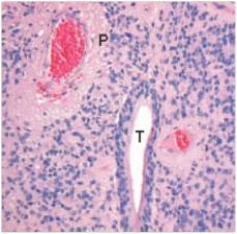 <strong>A 37 year old man had suffered from hemiplegia for several years.He had been told it was multiple sclerosis.A neurologist suspected that the diagnosis was incorrect,and ordered a CT scan of the patient's cervical spine.The scan revealed a central tumour,which was pressing on the corticospinal tract.A neurosurgeon was able to completely remove the tumour,which is shown in the accompanying photomicrograph.Which one of the following is the best diagnosis? </strong> A)Ependymoma B)Glioblastoma C)Meningioma D)Multiple sclerosis E)Oligodendroglioma