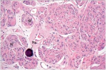 <strong>A 47 year old woman consulted her physician because of frequent headaches and weakness in her left arm.A CT scan showed a large 4 cm tumour on the right convexity,attached to the dura.It compressed,but did not invade the motor cortex.The tumour was easily removed.A representative section from the tumour is shown in the accompanying photomicrograph.Which one of the following is the best diagnosis? </strong> A)Ependymoma B)Glioblastoma C)Meningioma D)Multiple sclerosis E)Oligodendroglioma
