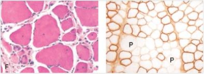 <strong>A 3 year old child was having difficulty walking.He had not met his developmental milestones.His legs actually looked quite strong,with apparently muscular calves.However,the paediatric neurologist ordered a muscle biopsy,which is shown in the accompanying photomicrograph.On the right is an immunohistochemical stain for dystrophin protein. </strong> A)Becker muscular dystrophy B)Duchenne muscular dystrophy C)Mitochondrial myopathy D)Neurogenic muscular atrophy E)Polymyositis