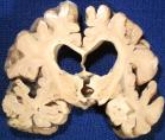 What loss of tissue is evident in this picture? Given that this came from an 80-year-old,is it possible to diagnosis a disorder based on this?