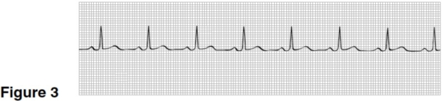 <strong>The rhythm in Figure 3 is  </strong> A)sinus tachycardia. B)sinus rhythm. C)sinus bradycardia. D)sinus arrhythmia. <div style=padding-top: 35px> 