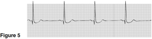 <strong>  In Figure 5,the rhythm shown is</strong> A)sinus rhythm. B)sinus bradycardia. C)sinus tachycardia. D)sinus block. <div style=padding-top: 35px> 