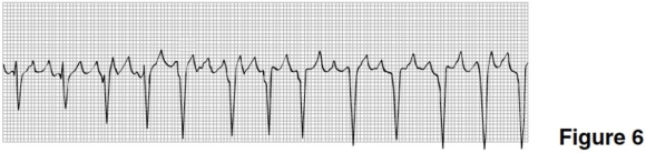 <strong>In Figure 6,the rhythm is </strong> A)sinus rhythm. B)atrial fibrillation. C)atrial flutter. D)SVT.