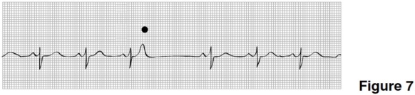 <strong>The rhythm in Figure 7 is </strong> A)sinus rhythm with a sinus arrest and a junctional escape beat. B)sinus arrhythmia. C)sinus rhythm with a nonconducted PAC. D)wandering atrial pacemaker.