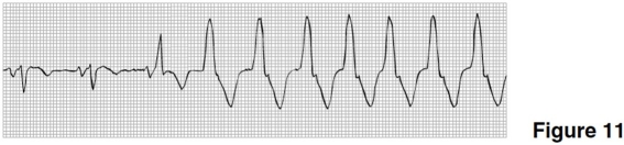 <strong>The rhythm in Figure 11 is </strong> A)atrial fibrillation. B)atrial flutter. C)sinus rhythm with a burst of PAT. D)sinus rhythm converting to ventricular tachycardia.