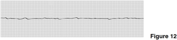 <strong> The rhythm in Figure 12 is</strong> A)P wave asystole. B)ventricular tachycardia. C)ventricular fibrillation. D)paced ventricular rhythm.