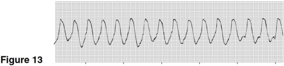 <strong>The rhythm in Figure 13 is </strong> A)atrial flutter. B)ventricular fibrillation. C)atrial tachycardia. D)ventricular tachycardia.
