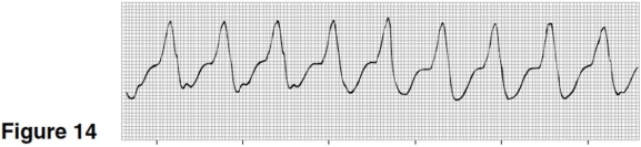 <strong> The rhythm in Figure 14 is</strong> A)ventricular tachycardia. B)accelerated idioventricular rhythm. C)sinus rhythm with PVCs. D)accelerated junctional rhythm.