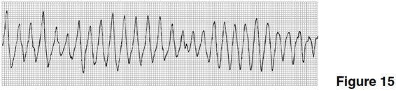 <strong>The rhythm in Figure 15 is </strong> A)agonal rhythm. B)ventricular tachycardia. C)torsades de pointes. D)ventricular fibrillation.