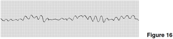 <strong> Treatment for the rhythm in Figure 16 would include which of the following?</strong> A)Electrical shock to the heart B)Atropine C)Digitalis D)Oxygen removal