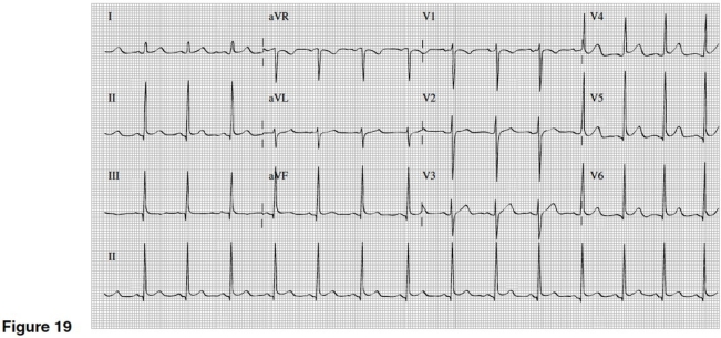 <strong> If you were told that Figure 19's EKG was of a young black male,you would think of what cause of mild widespread ST elevation?</strong> A)Pericarditis B)Inferior MI C)Early repolarization D)Right ventricular infarction