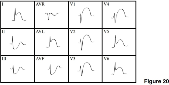 <strong> The MI in Figure 20 is</strong> A)extensive anterior (anterior-lateral). B)posterior. C)lateral. D)inferior.